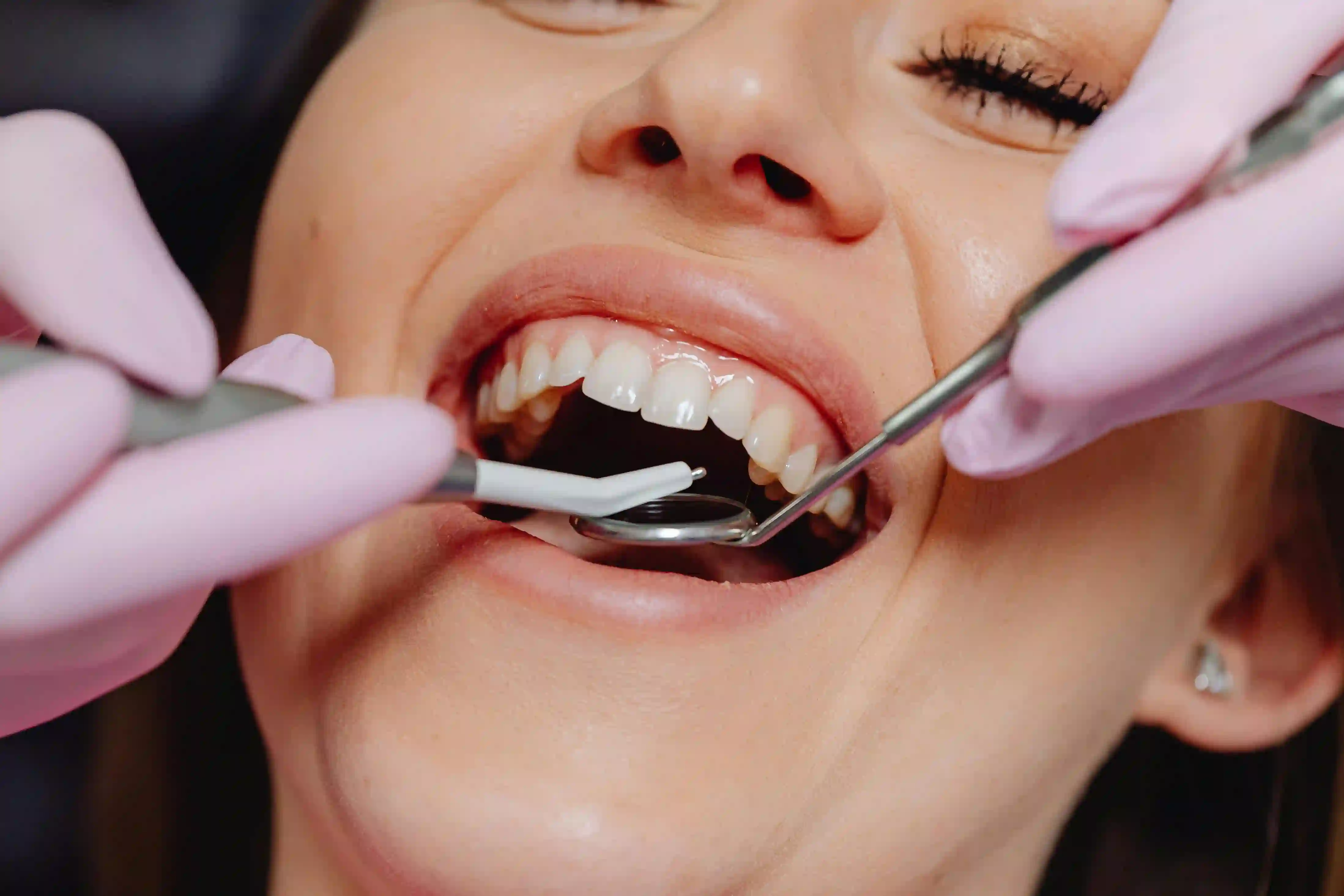 Limpieza Dental